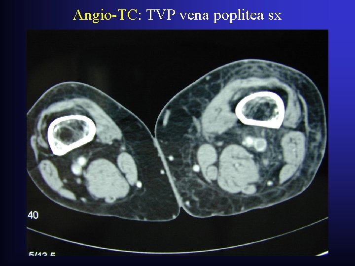 Angio-TC: TVP vena poplitea sx Angio-TC: TVP vena poplitea sx