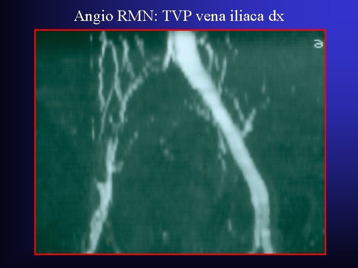 Angio RMN: TVP vena iliaca dx Angio RMN: TVP vena iliaca dx