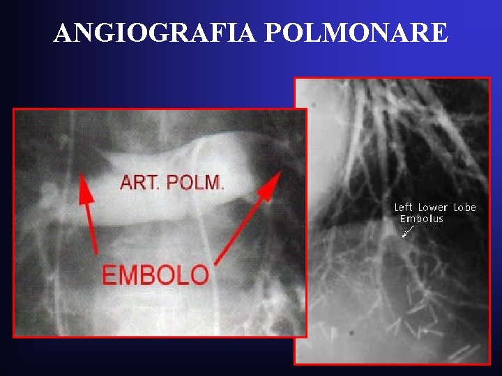 ANGIOGRAFIA POLMONARE ANGIOGRAFIA POLMONARE