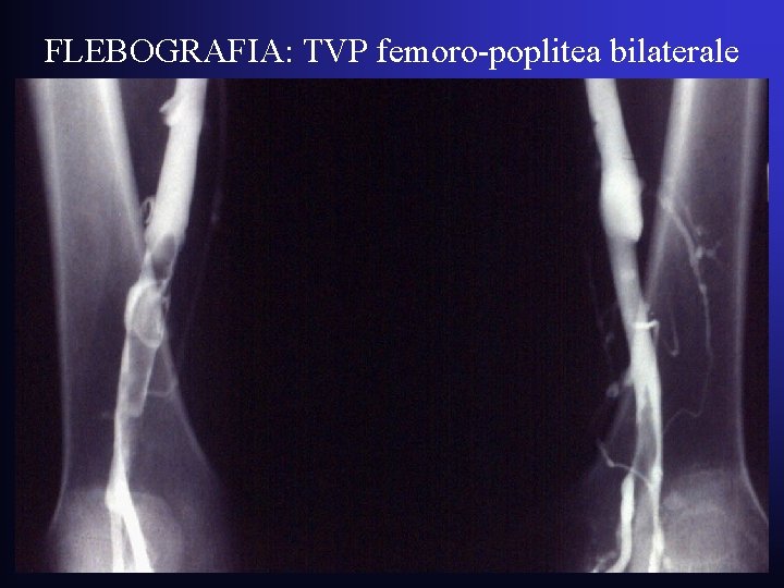 FLEBOGRAFIA: TVP femoro-poplitea bilaterale FLEBOGRAFIA: TVP femoro-poplitea bilaterale