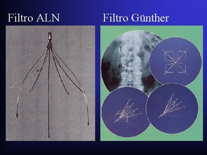 Filtro ALN Filtro Günther Filtro ALN Filtro Günther