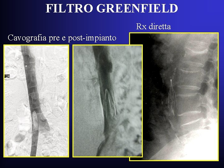 FILTRO GREENFIELD Rx diretta Cavografia pre e post-impianto FILTRO GREENFIELD Rx diretta Cavografia pre e post-impianto