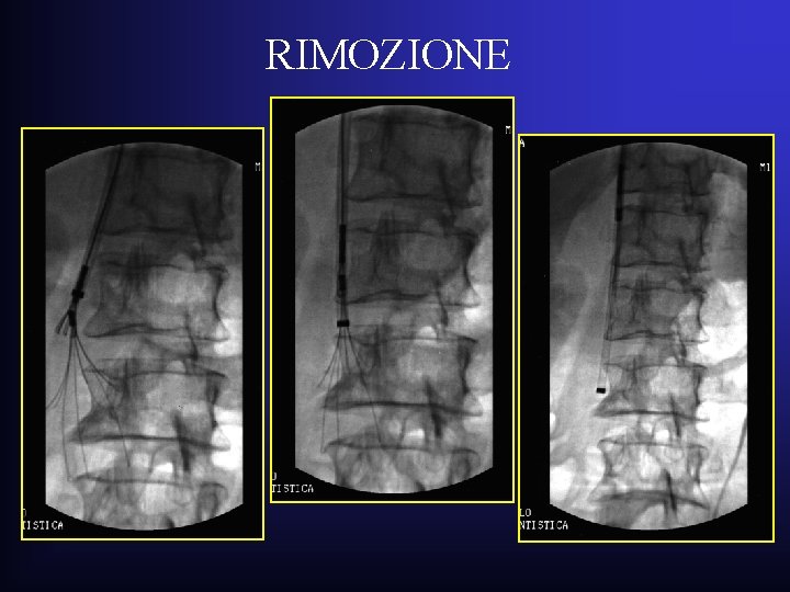 RIMOZIONE RIMOZIONE