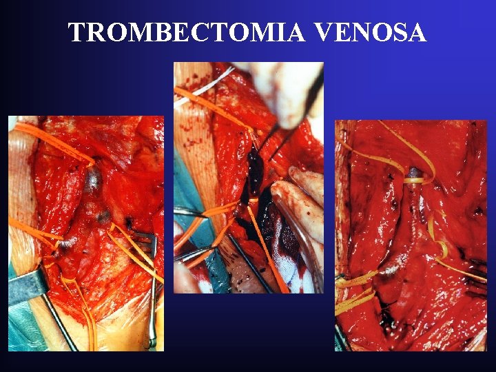TROMBECTOMIA VENOSA TROMBECTOMIA VENOSA