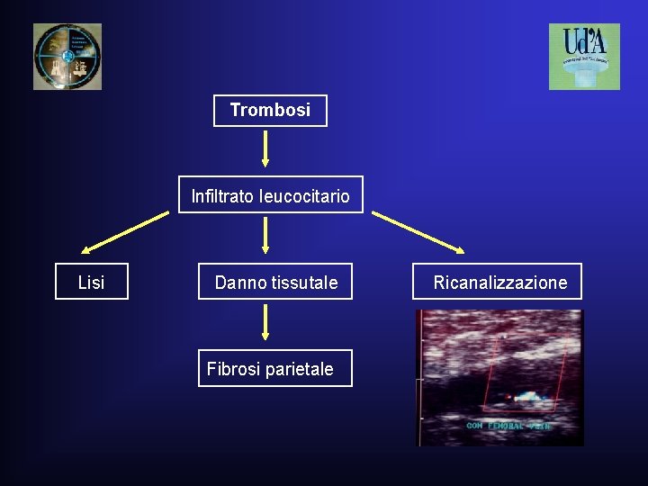 Trombosi Infiltrato leucocitario Lisi Danno tissutale Ricanalizzazione Fibrosi parietale Trombosi Infiltrato leucocitario Lisi Danno tissutale Ricanalizzazione Fibrosi parietale
