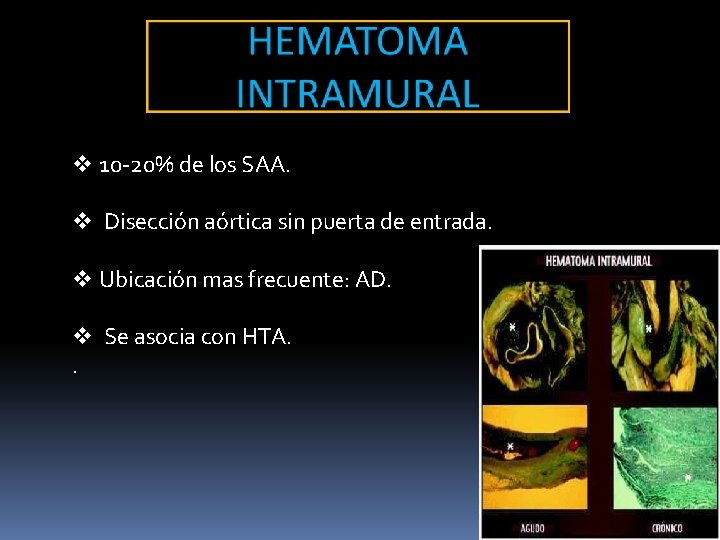 v 10 -20% de los SAA. v Disección aórtica sin puerta de entrada. v v 10 -20% de los SAA. v Disección aórtica sin puerta de entrada. v