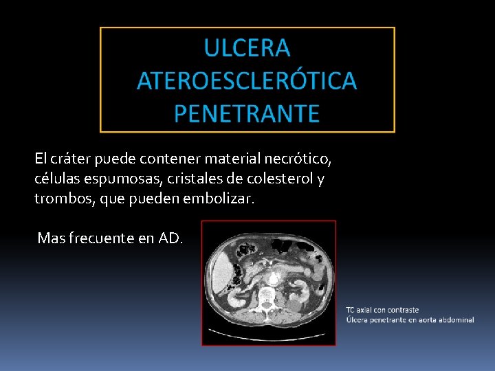 El cráter puede contener material necrótico, células espumosas, cristales de colesterol y trombos, que El cráter puede contener material necrótico, células espumosas, cristales de colesterol y trombos, que