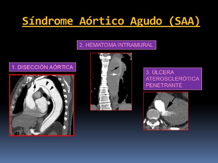 1. DISECCIÓN AÓRTICA 1. DISECCIÓN AÓRTICA