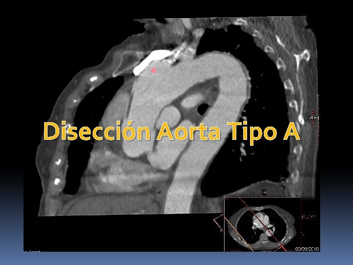 Disección Aorta Tipo A Disección Aorta Tipo A