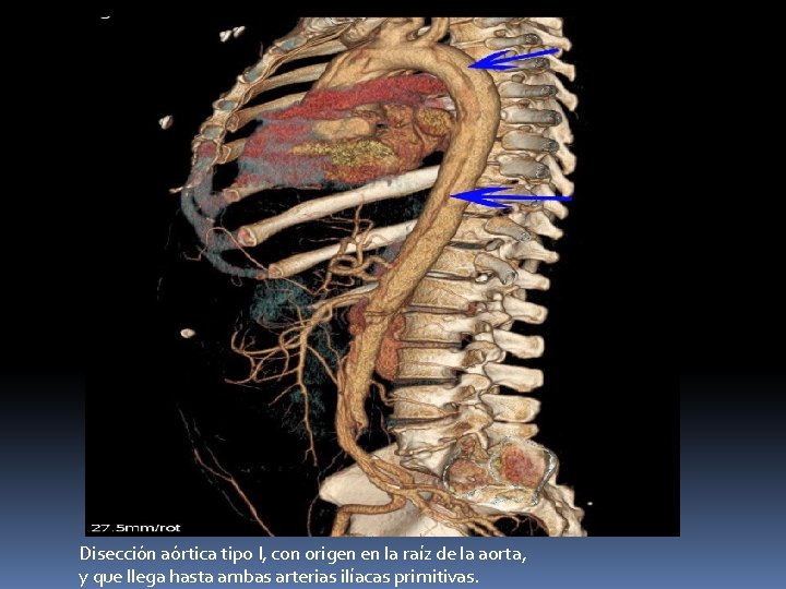 Disección aórtica tipo I, con origen en la raíz de la aorta, y que Disección aórtica tipo I, con origen en la raíz de la aorta, y que