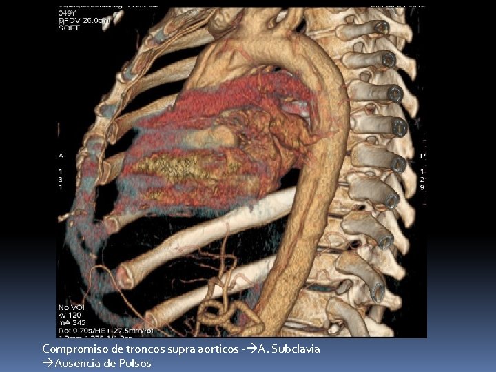 Compromiso de troncos supra aorticos - A. Subclavia Ausencia de Pulsos Compromiso de troncos supra aorticos - A. Subclavia Ausencia de Pulsos