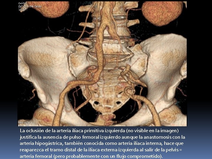 La oclusión de la arteria ilíaca primitiva izquierda (no visible en la imagen) justifica La oclusión de la arteria ilíaca primitiva izquierda (no visible en la imagen) justifica