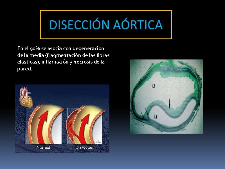 En el 90% se asocia con degeneración de la media (fragmentación de las fibras En el 90% se asocia con degeneración de la media (fragmentación de las fibras