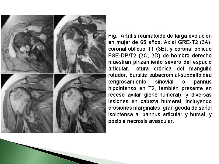 Fig. Artritis reumatoide de larga evolución en mujer de 65 años. Axial GRE-T 2