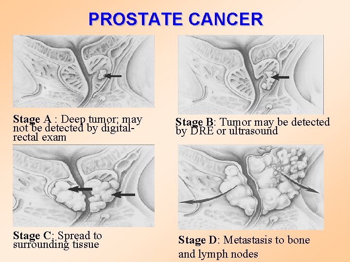 PROSTATE CANCER Stage A : Deep tumor: may not be detected by digitalrectal exam
