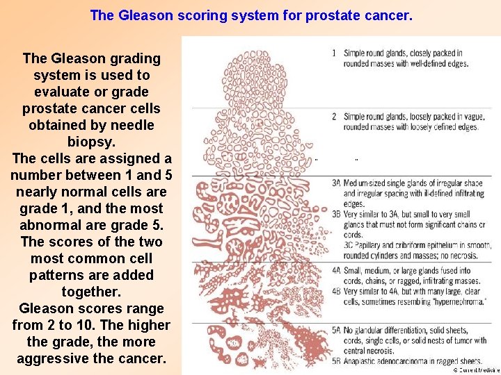 The Gleason scoring system for prostate cancer. The Gleason grading system is used to