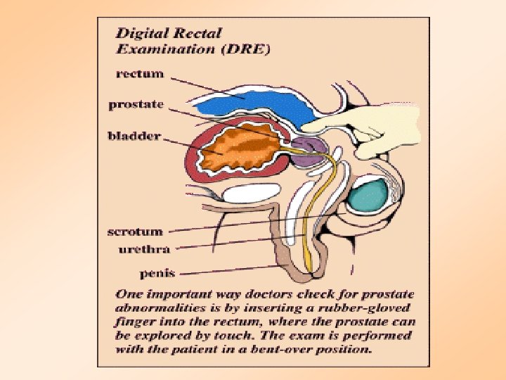 Digital Rectal Exam for Prostate Tumors 