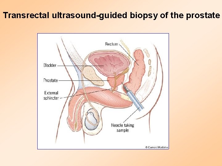 Transrectal ultrasound-guided biopsy of the prostate 