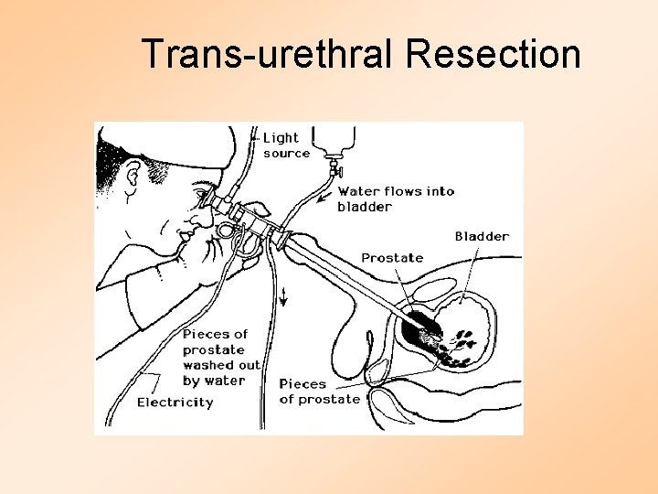 Trans-urethral Resection 