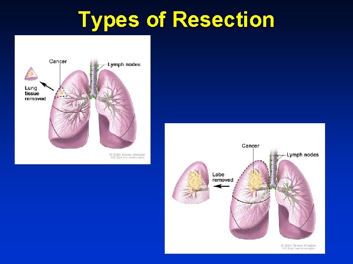 Types of Resection 