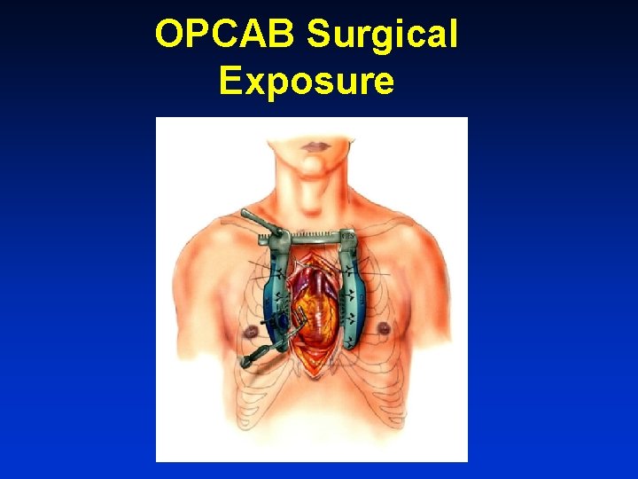 OPCAB Surgical Exposure 