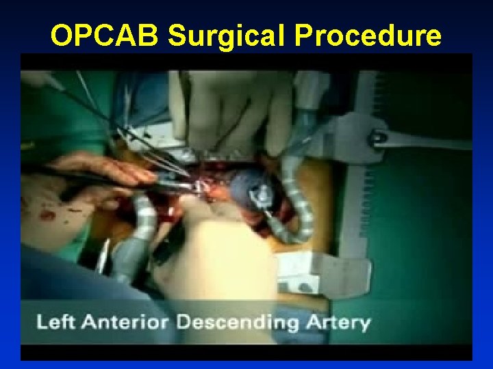 OPCAB Surgical Procedure 