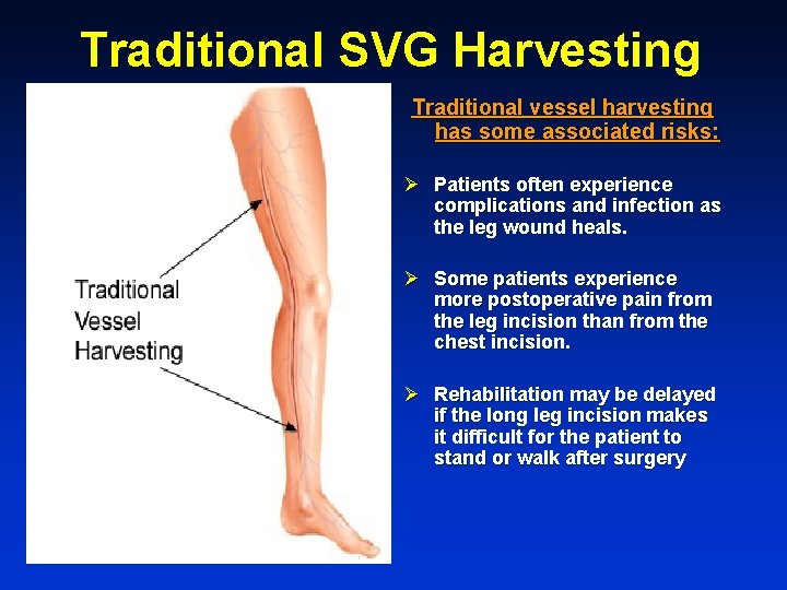 Traditional SVG Harvesting Traditional vessel harvesting has some associated risks: Ø Patients often experience