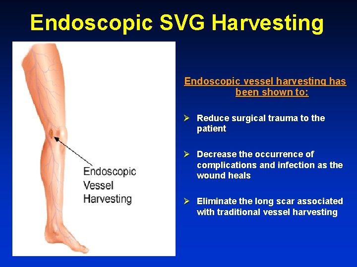 Endoscopic SVG Harvesting Endoscopic vessel harvesting has been shown to: Ø Reduce surgical trauma