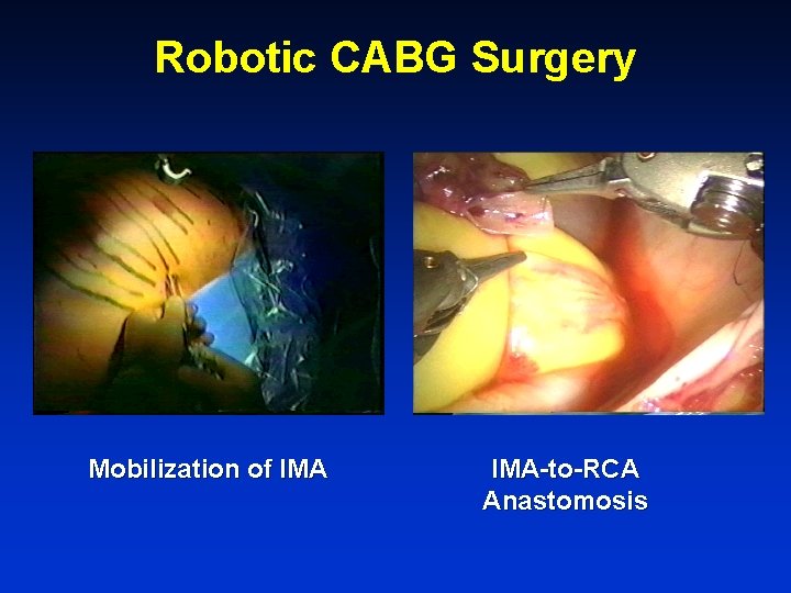 Robotic CABG Surgery Mobilization of IMA-to-RCA Anastomosis 
