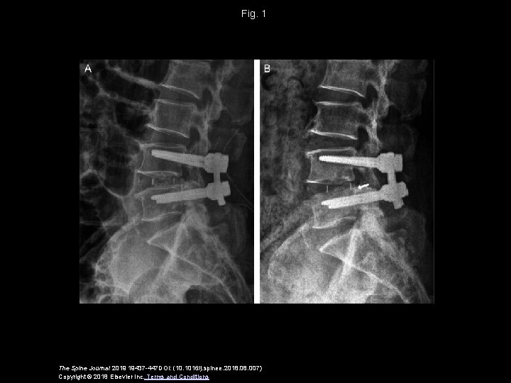 Fig. 1 The Spine Journal 2019 19437 -447 DOI: (10. 1016/j. spinee. 2018. 007)