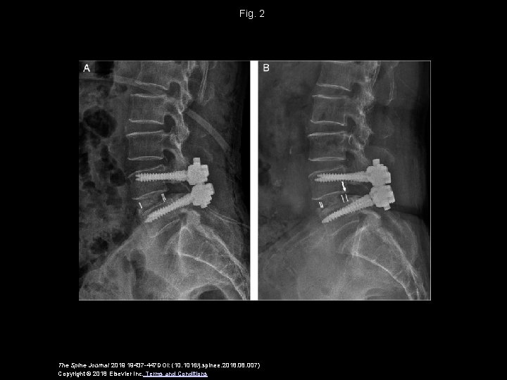 Fig. 2 The Spine Journal 2019 19437 -447 DOI: (10. 1016/j. spinee. 2018. 007)