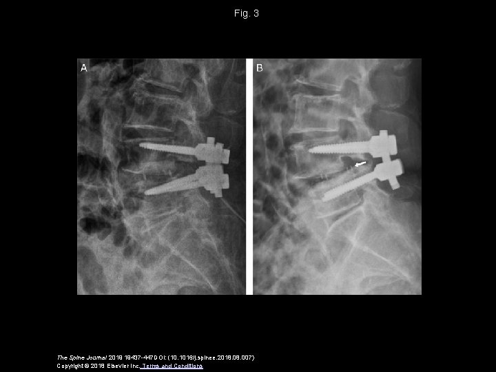 Fig. 3 The Spine Journal 2019 19437 -447 DOI: (10. 1016/j. spinee. 2018. 007)