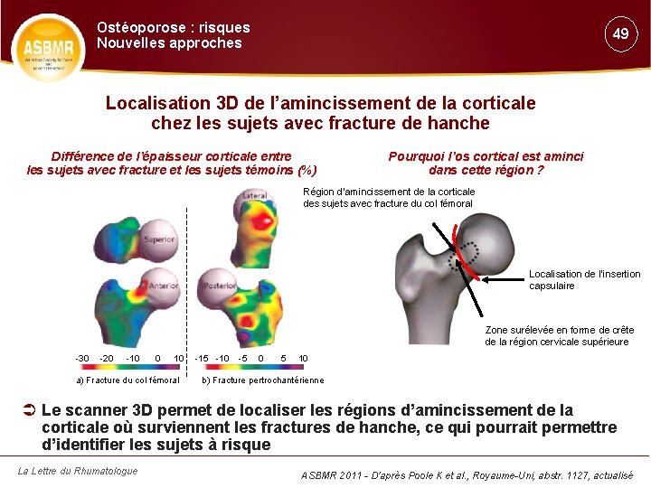 Ostéoporose : risques Nouvelles approches 49 Localisation 3 D de l’amincissement de la corticale