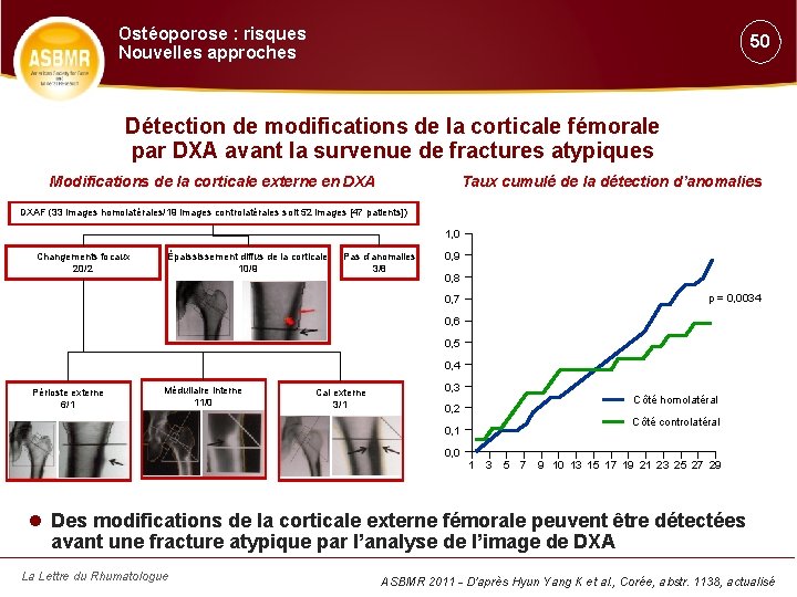 Ostéoporose : risques Nouvelles approches 50 Détection de modifications de la corticale fémorale par