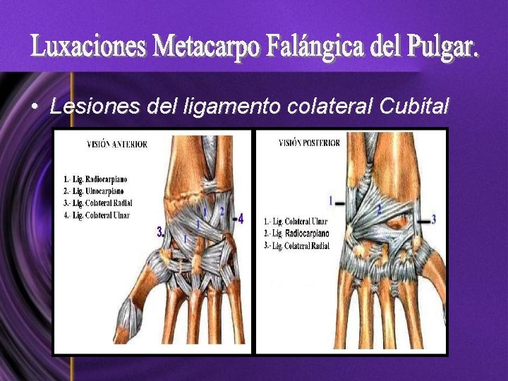  • Lesiones del ligamento colateral Cubital 