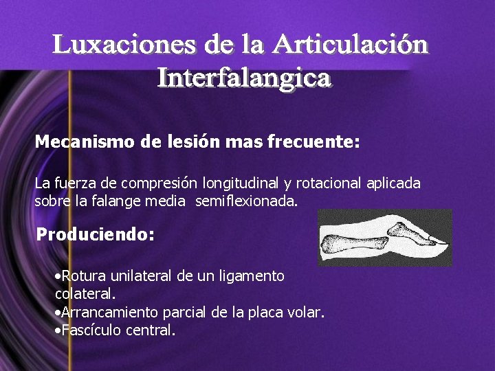 Mecanismo de lesión mas frecuente: La fuerza de compresión longitudinal y rotacional aplicada sobre
