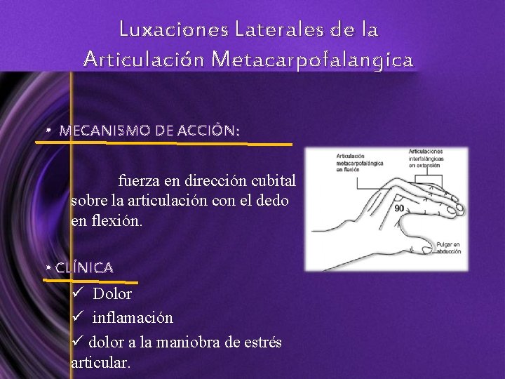 Luxaciones Laterales de la Articulación Metacarpofalangica • MECANISMO DE ACCIÓN: fuerza en dirección cubital