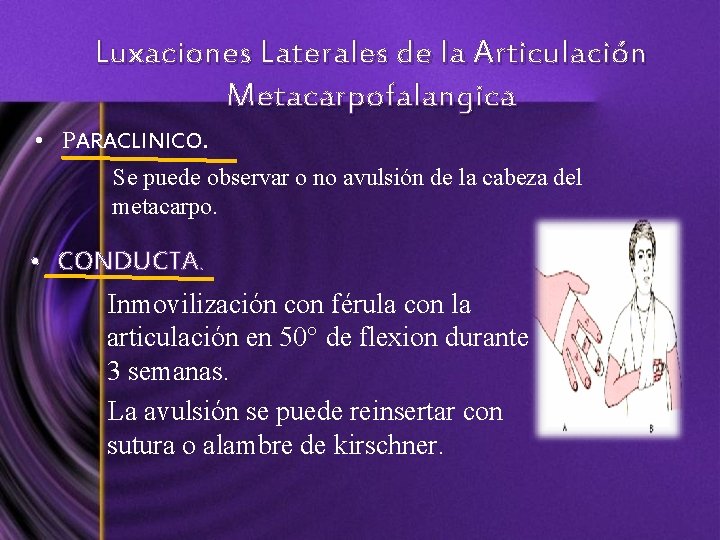 Luxaciones Laterales de la Articulación Metacarpofalangica • PARACLINICO. Se puede observar o no avulsión