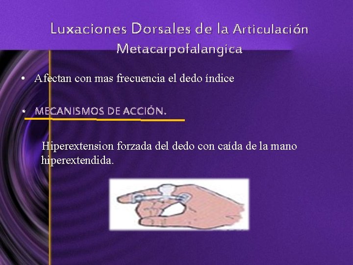 Luxaciones Dorsales de la Articulación Metacarpofalangica • Afectan con mas frecuencia el dedo índice