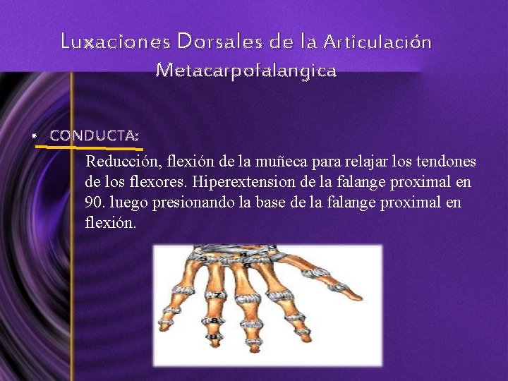 Luxaciones Dorsales de la Articulación Metacarpofalangica • CONDUCTA: Reducción, flexión de la muñeca para