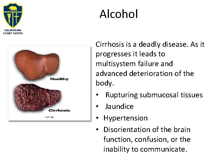 Alcohol Cirrhosis is a deadly disease. As it progresses it leads to multisystem failure