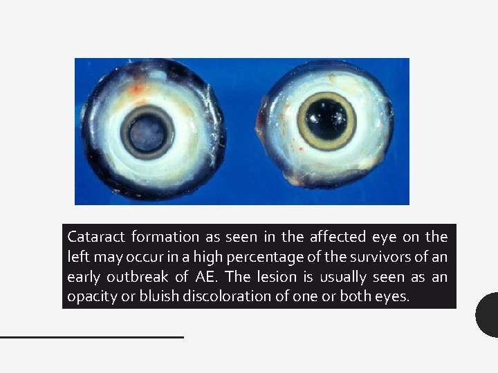 Cataract formation as seen in the affected eye on the left may occur in