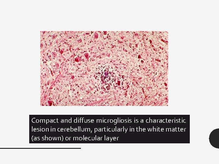 Compact and diffuse microgliosis is a characteristic lesion in cerebellum, particularly in the white Compact and diffuse microgliosis is a characteristic lesion in cerebellum, particularly in the white
