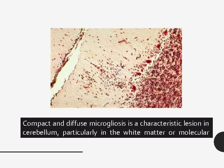 Compact and diffuse microgliosis is a characteristic lesion in cerebellum, particularly in the white