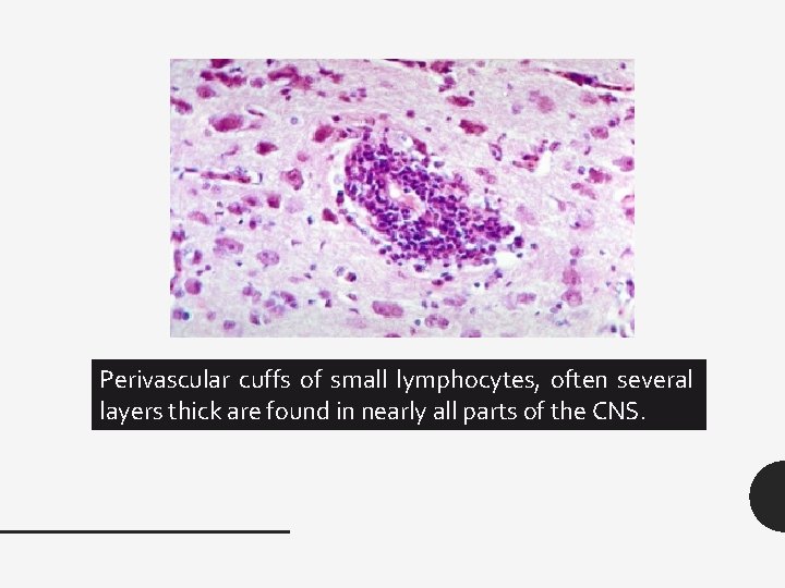 Perivascular cuffs of small lymphocytes, often several layers thick are found in nearly all