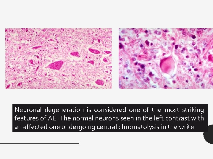 Neuronal degeneration is considered one of the most striking features of AE. The normal