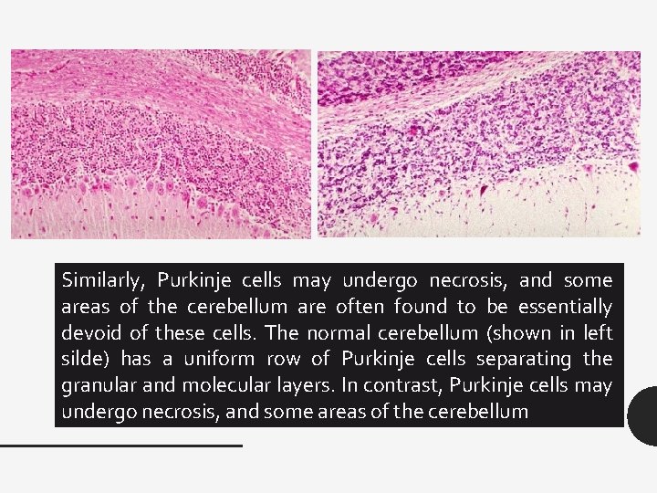 Similarly, Purkinje cells may undergo necrosis, and some areas of the cerebellum are often