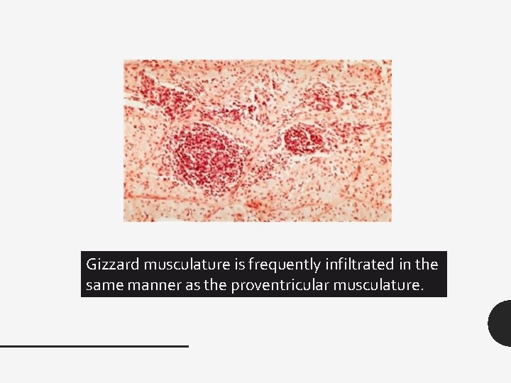 Gizzard musculature is frequently infiltrated in the same manner as the proventricular musculature. 