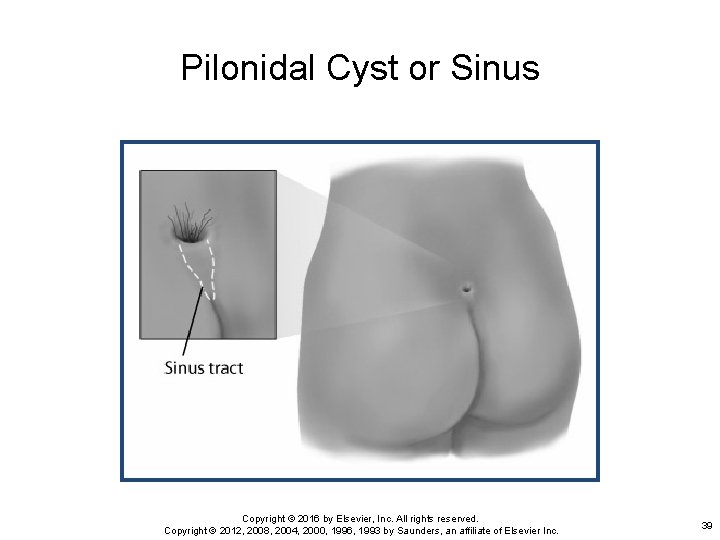 Pilonidal Cyst or Sinus Copyright © 2016 by Elsevier, Inc. All rights reserved. Copyright
