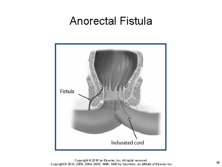 Anorectal Fistula Copyright © 2016 by Elsevier, Inc. All rights reserved. Copyright © 2012,